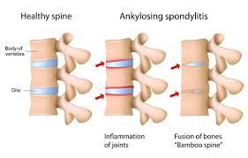 Ankylosing spondylitis treatment