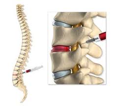 Intradiscal injection for back pain