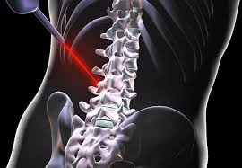 laser treatment for back pain